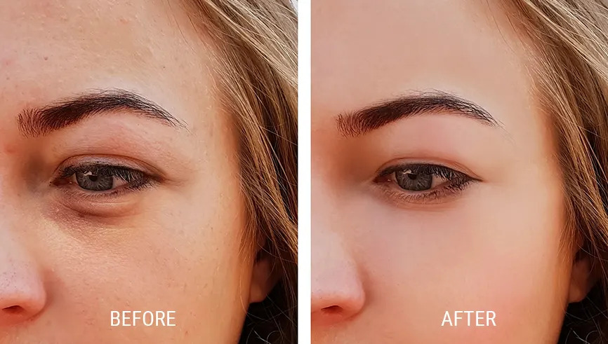 What really causes under-eye hollows and dark circles?